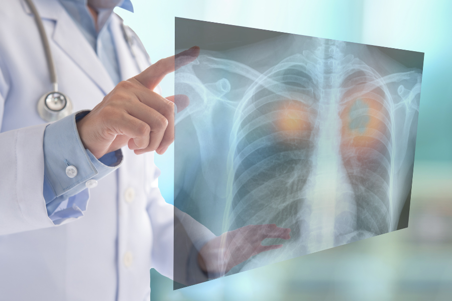 Lung Cancer Screening at Logan Health